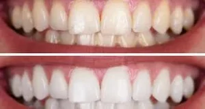 چند راه ساده برای داشتن لبخند سفید بدون بلیچینگ 