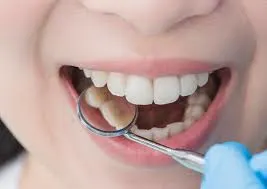 اشتباهات رایج در مراقبت از دندان‌ها بعد از غذا خوردن