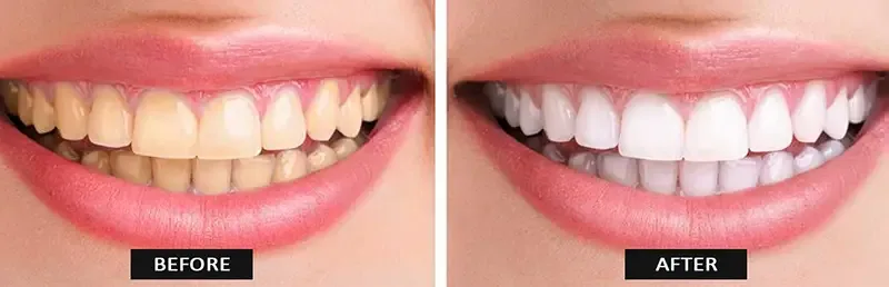 تفاوت کامپوزیت، لمینت و بلیچینگ در سفید کردن دندان‌ها