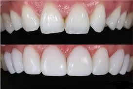 مواد جدید در ترمیم دندان؛ تفاوت کامپوزیت‌های نانو با نسل قدیمی 