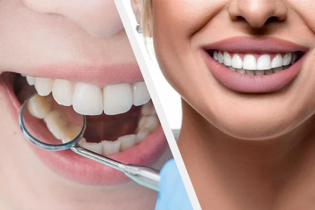 مواد جدید در ترمیم دندان؛ تفاوت کامپوزیت‌های نانو با نسل قدیمی