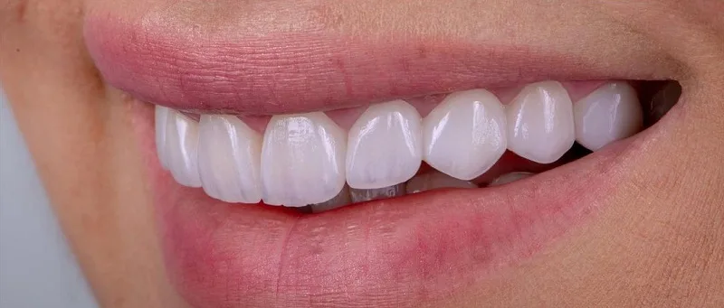 ایمپلنت فوری یا مرحله‌ای؟ بررسی مزایا و معایب هرکدام از نگاه متخصصان کاشان