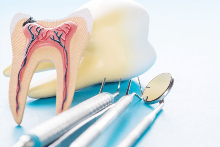 نشانههای پوسیدگی دندان از داخل؛ زمانی که هیچ درد یا تغییر رنگی دیده نمیشود